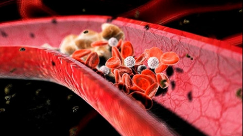 Четири симптома, които алармират за кръвен съсирек