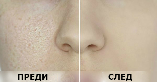 Как да махнем черните точки завинаги? 7 натурални метода, които ще ви отърват от тях!