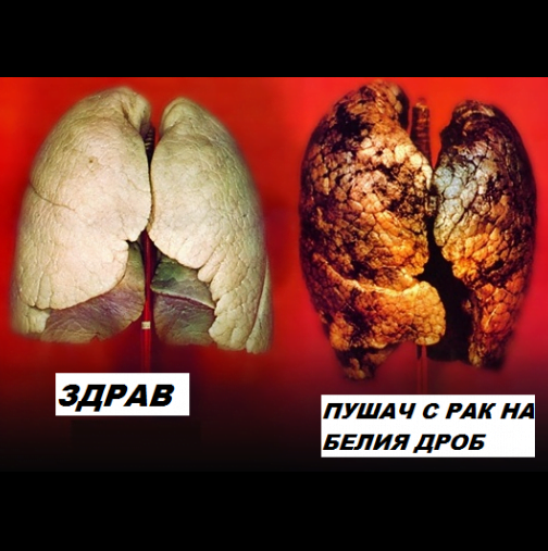 Как най- лесно може да разберете дали имате рак на белия дроб? 8 признака, които ви алармират всеки ден –