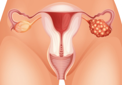 5 тихи симптома за рак на яйчниците при жените, които пропускаме! Всяка от нас трябва да ги знае!