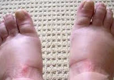 Отеклите крака превърнаха живота ми в същински ад, но с този бабин лек подуването изчезва само за три дни