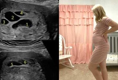 Бременна жена отива на ултразвук, вижда 6 черни кръга около бебето си на екрана